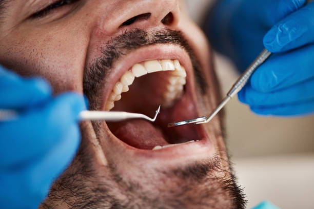 Dental Bonding in Palermo, NJ